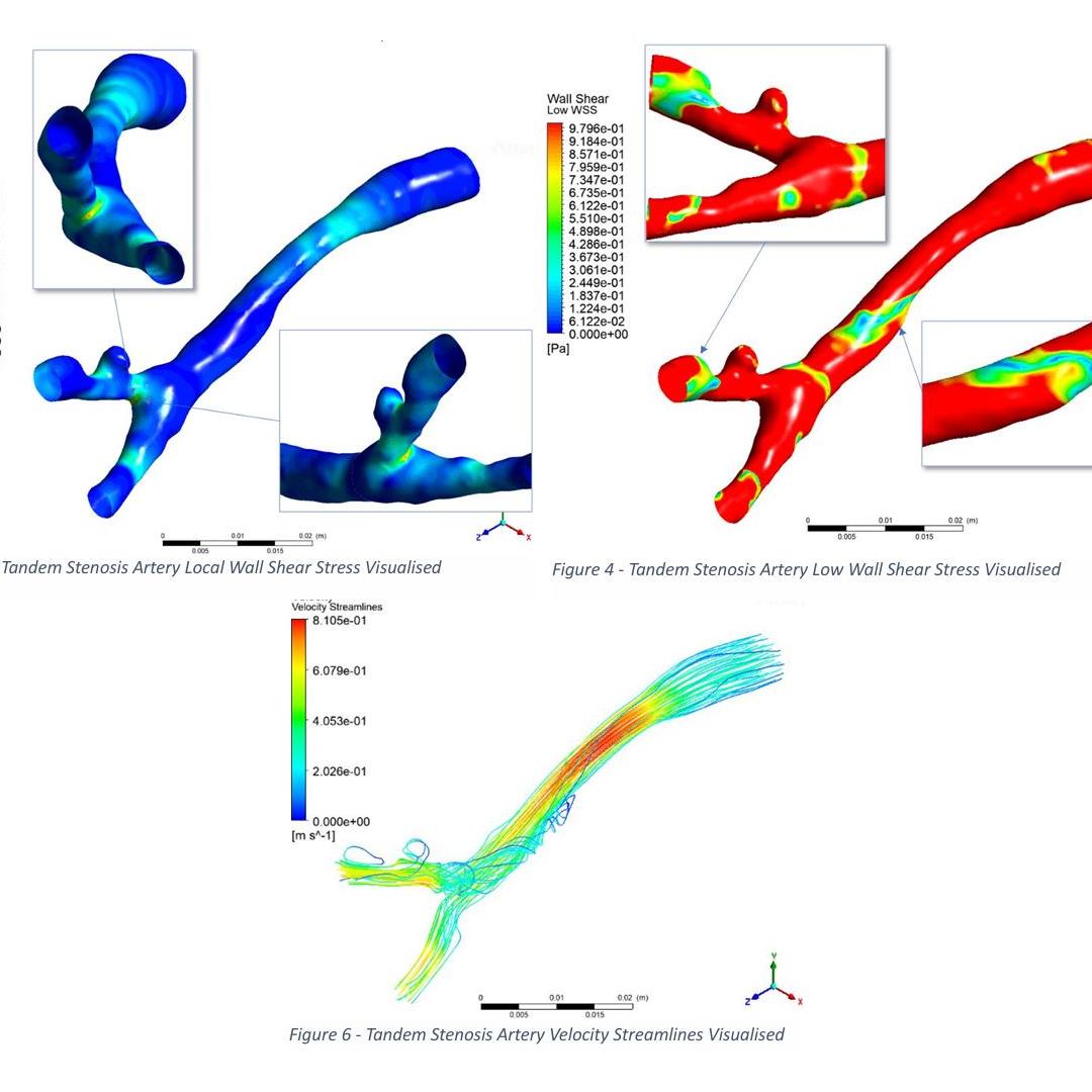 Tanden Stenosis Artery CFD