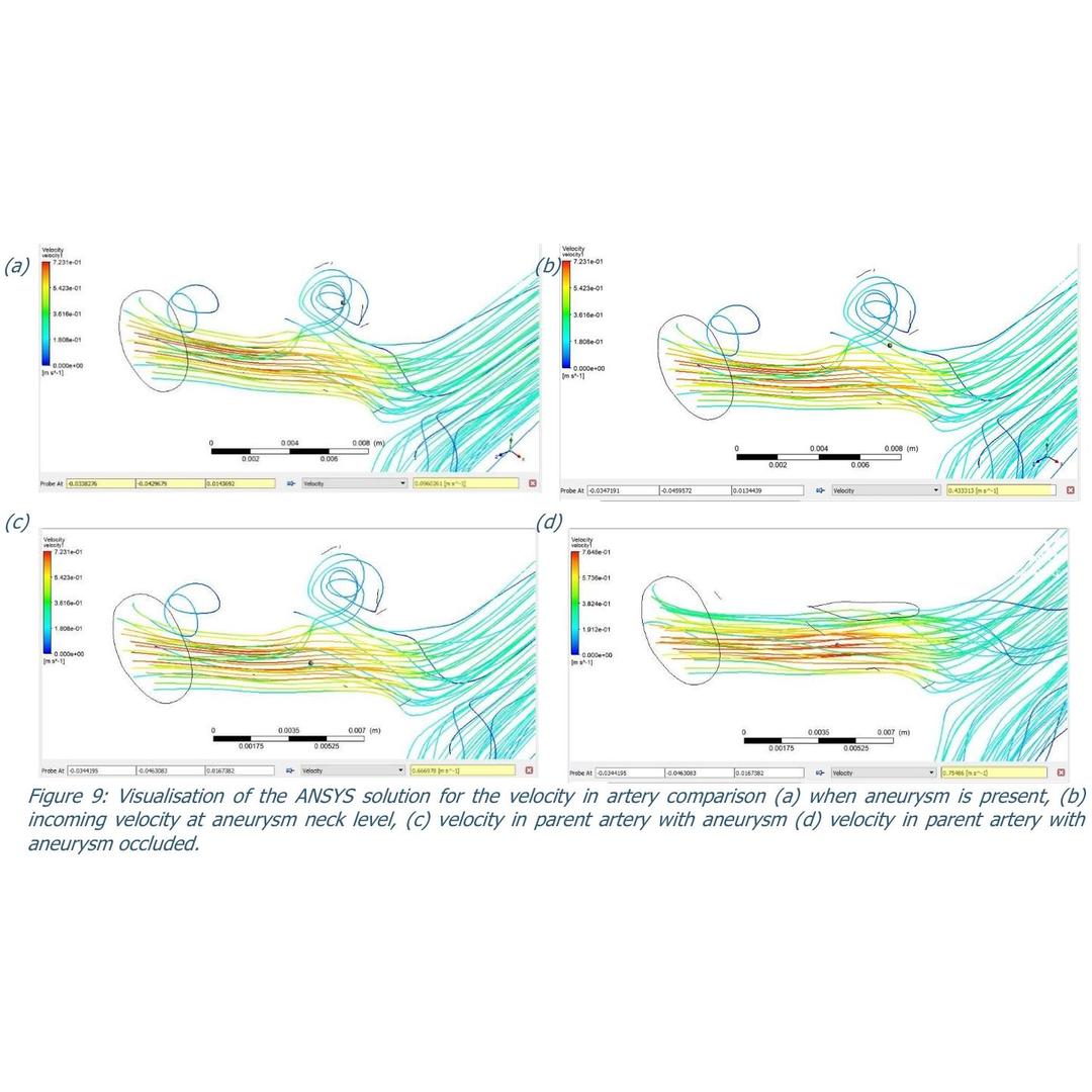 Aneurysm CFD