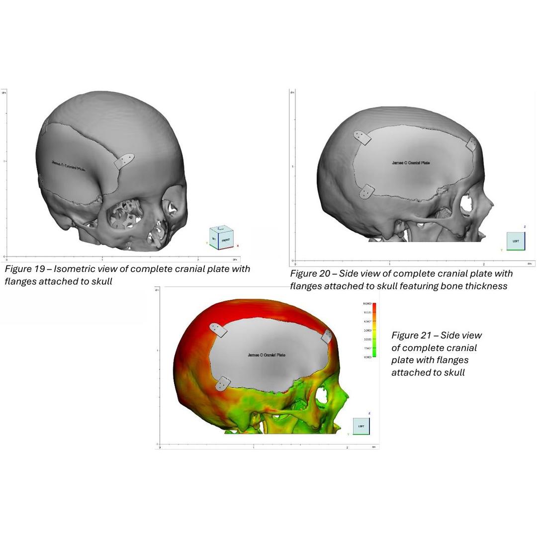 Patient Specific Cranial Prothesis