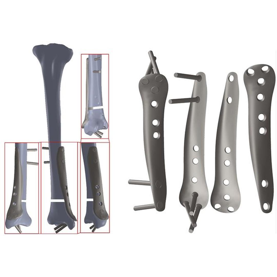 Patient Specific Distal Tibia Fracture Fixation Device